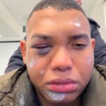 Miguel Polo Polo sufre accidente en monopatín y enseña las lesiones sufridas en su rostro.